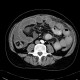Peritoneal dialysis, complication, fluid collection, gigantic, before: CT - Computed tomography